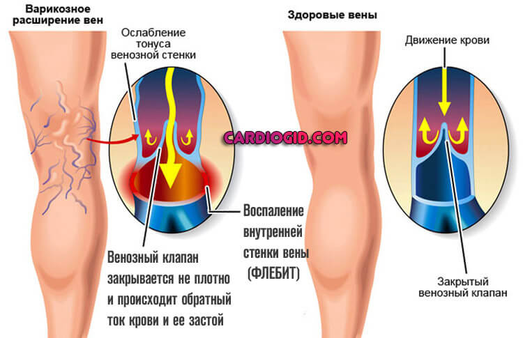 Варикозное Расширение Вен На Ногах Симптомы